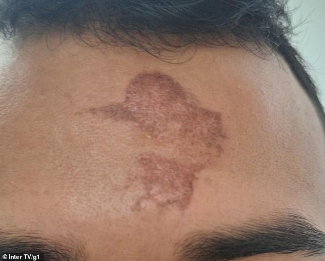 Ash Wednesday Cross Ritual Leaves Churchgoers with Mysterious Forehead Burns