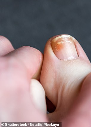 Experts Decode Toenail Clues: What Your Nails Reveal About Health