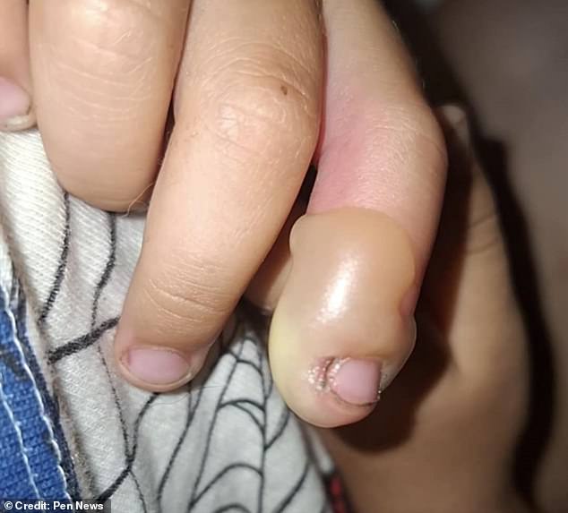 Toddler Suffers Plum-Sized Blister After Encounter With Britain’s Toxic Giant Hogweed in Newcastle