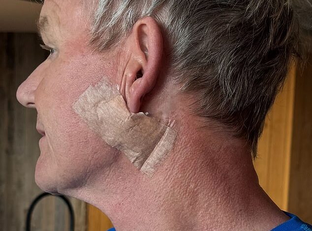 Title: Gordon Ramsay Reveals Skin Cancer Scare, Shares Post-Surgery Photos After Basal Cell Carcinoma Removal