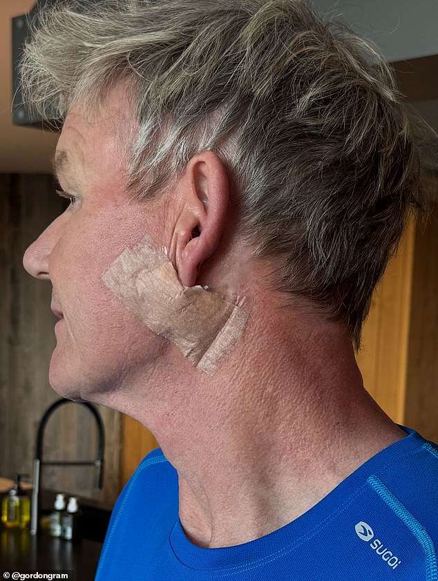 Title: Gordon Ramsay Reveals Skin Cancer Scare, Shares Post-Surgery Photos After Basal Cell Carcinoma Removal
