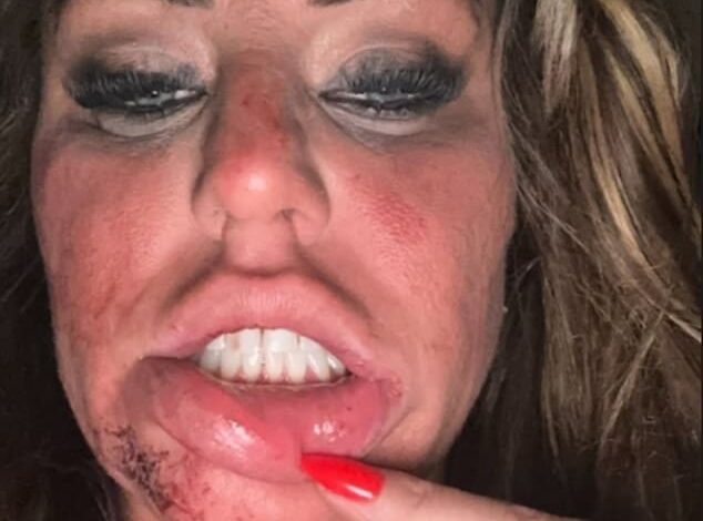 Title: Danielle Mason Shares Image of Bruised, Bloodied Face Alleging Ex-Fiancé Attacked Her on Engagement Party Night