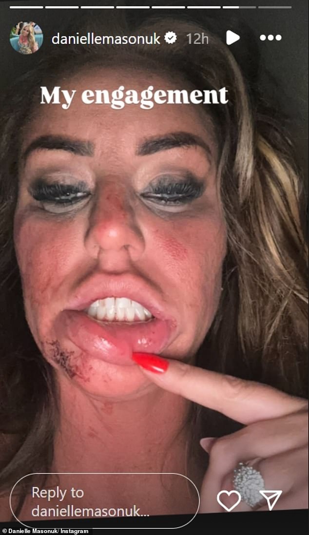 Title: Danielle Mason Shares Image of Bruised, Bloodied Face Alleging Ex-Fiancé Attacked Her on Engagement Party Night