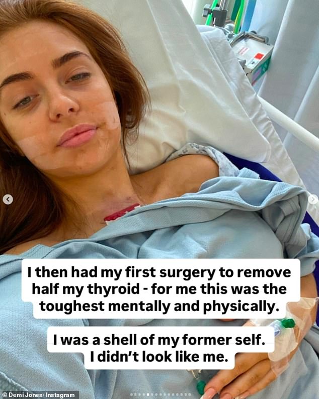 Title: Love Island’s Demi Jones Opens Up About Thyroid Cancer Diagnosis at 22  
Rationale: The revised title condenses key details (her identity, health battle, age at diagnosis) while removing redundancy ("after being diagnosed") and maintaining clarity and emotional resonance.